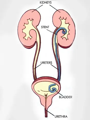 DJ Stenting Procedure Doctor in Indore